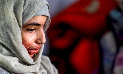 defiguree-a-l&rsquo;acide,-al-anoud,-19-ans,-visage-des-femmes-brutalisees-au-yemen