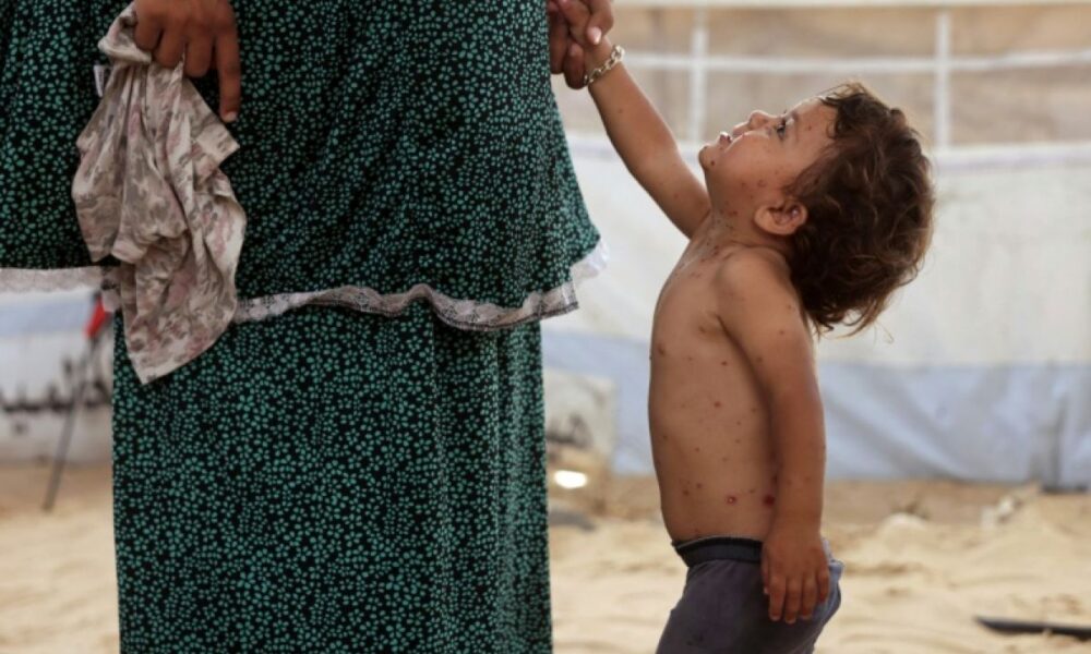 Varicelle à Gaza les enfants grattent leurs boutons dans des tentes sans hygiène