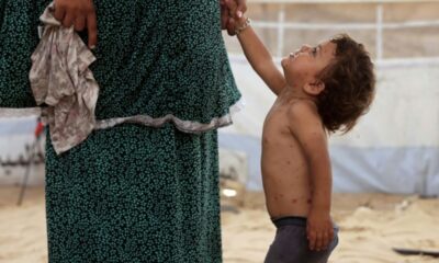 Varicelle à Gaza les enfants grattent leurs boutons dans des tentes sans hygiène