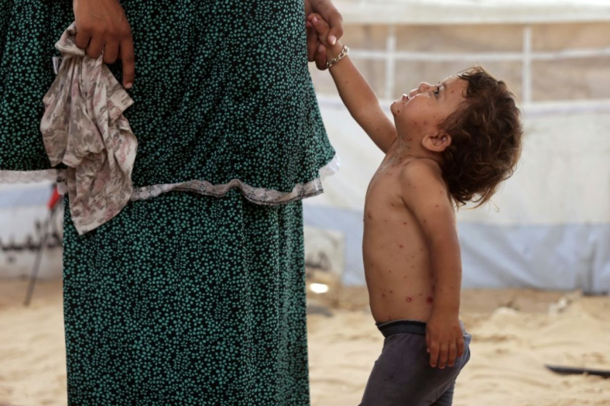 Varicelle à Gaza les enfants grattent leurs boutons dans des tentes sans hygiène