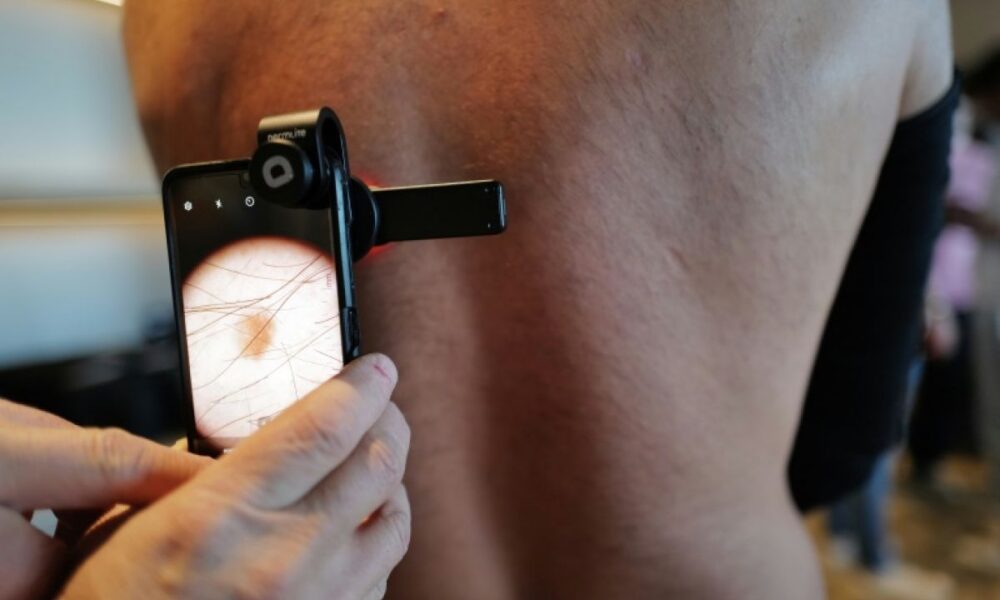 Des kinés appelés à repérer les mélanomes pour court-circuiter l'attente chez le dermatologue