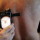 Des kinés appelés à repérer les mélanomes pour court-circuiter l'attente chez le dermatologue