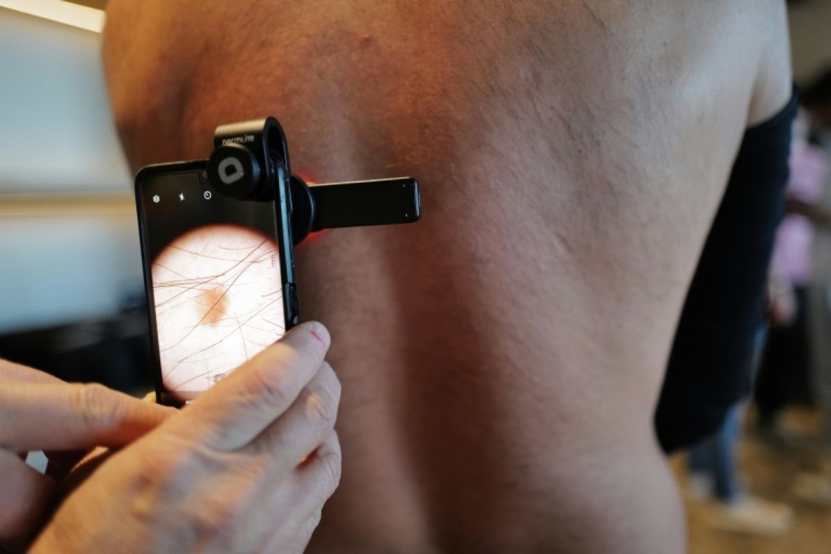 Des kinés appelés à repérer les mélanomes pour court-circuiter l'attente chez le dermatologue